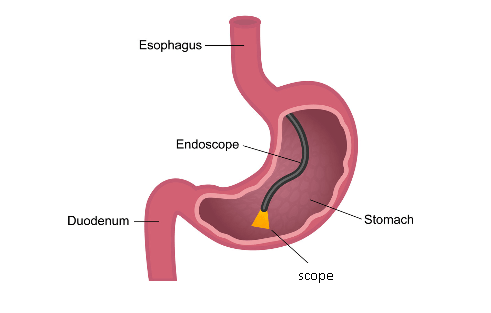Gastroscopy
